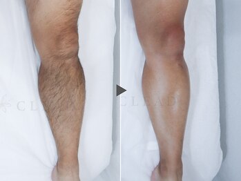 クリード(CLEAD)/メンズ/膝下脱毛