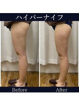 ハリルル 併設 GLケンタ鍼灸整骨院(HARILULU)/ハイパーナイフ　B/A