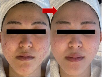 ブリリアン デイスパ 阪急西宮ガーデンズ店(BRILLIAN DAYSPA)/水光ピーリング