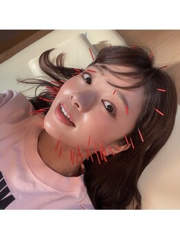 じんゆう鍼灸整体院/モデルの川村茉由さんにも美容鍼