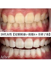 ホワイト 福岡博多店(WHITE)/ホワイトニングビフォーアフター