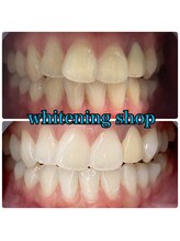 ホワイトニングショップ 大阪玉造店/Before&After美白ホワイトニング