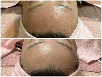 エステティックサロン アールグレー/ニキビ改善／肌質改善