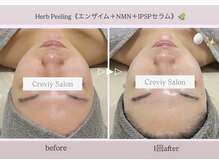 クレヴィー(Creviy)/陶肌トリートメント