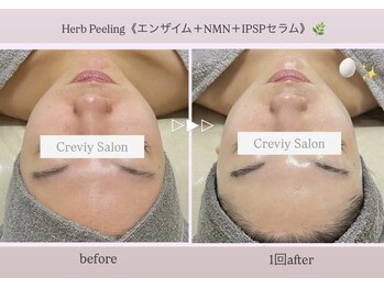 クレヴィー(Creviy)/陶肌トリートメント