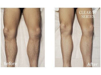 アットイカウ 下北沢(at ikaw)/下半身脱毛 Before/After