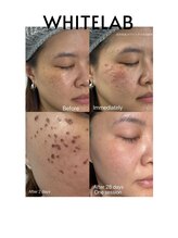 メイリー(Maylie)/WHITELAB/症例写真