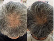 カナエル ビューティーサロン(Canael Beauty salon)/プロセルセラピーズ　4回