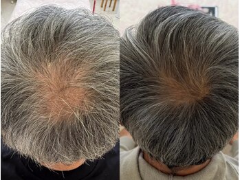 カナエル ビューティーサロン(Canael Beauty salon)/プロセルセラピーズ 4回