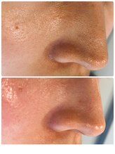 ポルトボーテ(Porte Beaute)/毛穴洗浄で毛穴レスへ