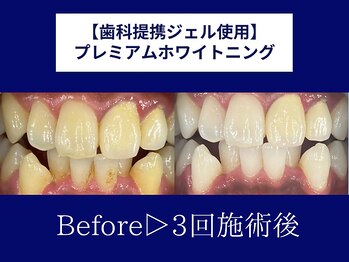 ホワイトニングカフェ 奈良新大宮店(WhiteningCafe)/◎歯のホワイトニング施術写真◎
