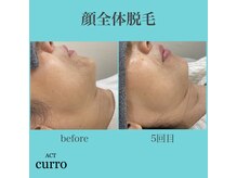 アクト クロ(ACT curro)/【顔全体】脱毛施術例
