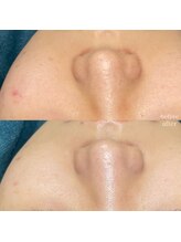 ちらちゅら/クリスティーナ【施術3回】