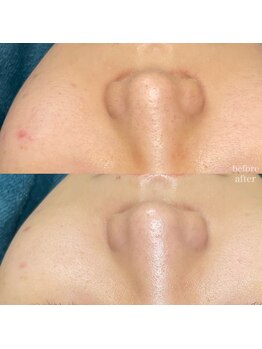 ちらちゅら/クリスティーナ【施術3回】