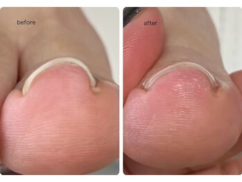 ロンディネ(Rondine)/巻き爪ケア/ネイルトリム9