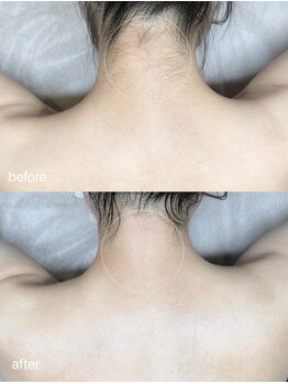 ポアラ(POARA)/毛穴/ワックス脱毛