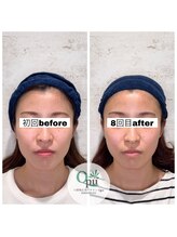 キュープ 相模原淵野辺店(Qpu)/たった4回で人生で1番小さな顔に