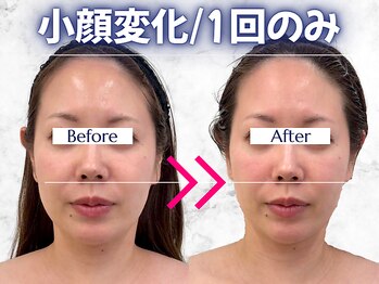 パッパ(PAPPA)/一撃変化｜衝撃波/小顔