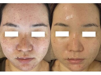 アネモネ(ANEMONE)/プロセルフェイシャル