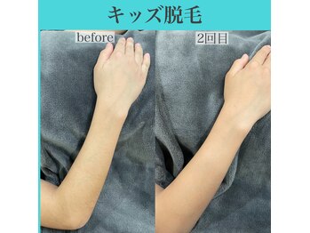 アクト クロ(ACT curro)/【キッズ】脱毛施術例