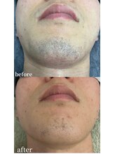 シャイン 熊本店(SHINE)/ヒゲ脱毛無料キャンペーン開催中