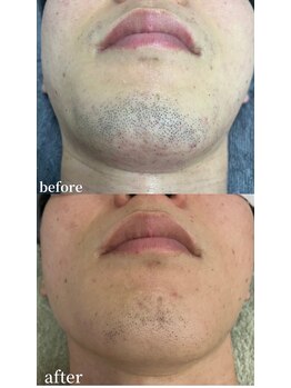 シャイン 熊本店(SHINE)/ヒゲ脱毛無料キャンペーン開催中