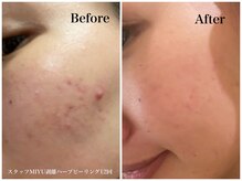 ハーブのほし/スタッフMIYUも剥離ハーブで改善