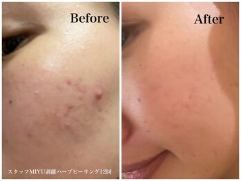 ハーブのほし/スタッフMIYUも剥離ハーブで改善