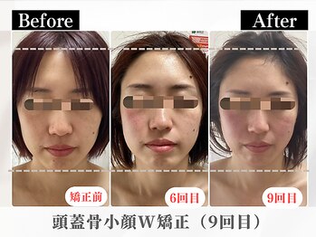 ポーベルポー(Peau Belle poe)/頭蓋骨小顔W矯正＋選べるパック