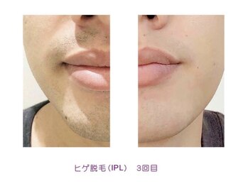 アカヌケ(AKANUKE)/ヒゲ脱毛