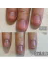 30代　噛み爪