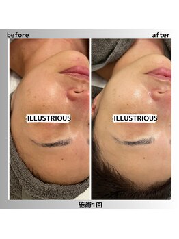 アガットバイミヤモト(agate by miyamoto)/イラストリアス（美白）施術1回