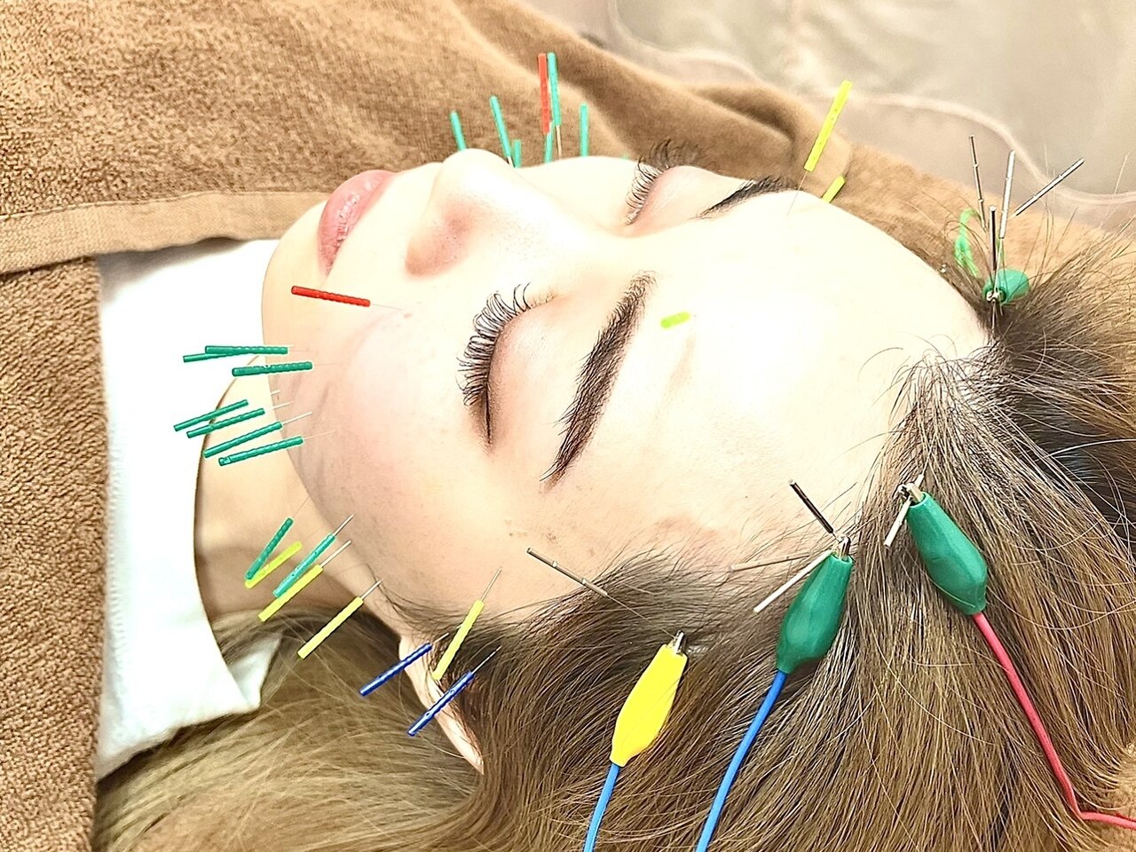 初回/残5名《しわ/たるみ/むくみ/眼精疲労改善》リフトUP美容鍼 7,700→1,980