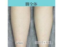 アクト クロ(ACT curro)/【脚全体】脱毛施術例