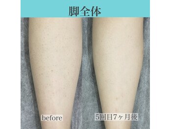 アクト クロ(ACT curro)/【脚全体】脱毛施術例