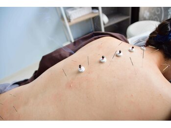 ここのはりきゅう治療院の写真/東洋医学を用いた施術＋女性鍼灸師が担当♪お悩みにあったオーダーメイド鍼・お灸◎