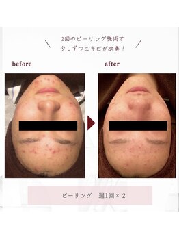 ファヴォリ(favori)/透光ピーリング