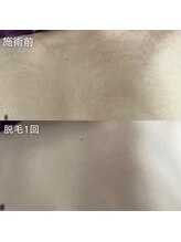 サロンリアンジュ ひたちなか店(Salon Liange)/背中脱毛◇後ろ姿に自信を！！