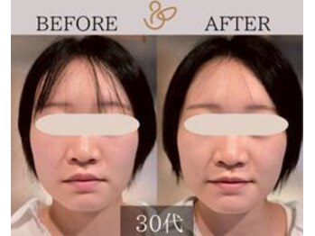 チョコバリ 新宿店(chocobari)/小顔×リフトアップ(美容鍼)30代