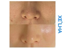 シューラディアント(ShuRadiant)/韓国セラピール