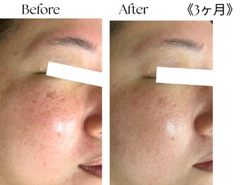 ウィズマツオカ 光の森店/シミさよらならケア