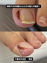 巻き爪じゅん 千葉駅前店/他で断られた陥入爪も諦めない