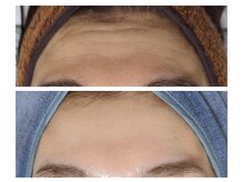 エボルブ 四条烏丸店(EVOLVE)/額のシワ改善！