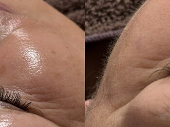 プレシャス(Precious)の写真/ 【劇的変化に感動！】産毛も古い角質も一掃するフェイシャルワックス脱毛◎お化粧ノリもトーンもUP♪
