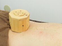 押上接骨鍼灸マッサージ院/箱灸というものも使ったりします