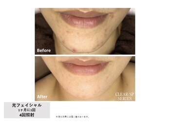 エミルカ(EMILUCA)/光フェイシャル