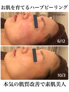 ル ミュー(le mieux)/剥離しないハーブピーリング