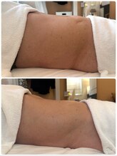 ネムリザサロン 武蔵小杉 新丸子(NEMURI the salon)/80代女性【YOLO式腸もみ】