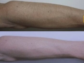 ヴィオール 名古屋栄店(VIOR)/【メンズ脱毛】 腕