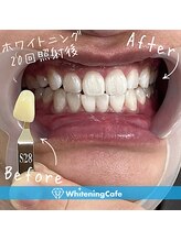 歯のホワイトニングWhiteningCafe六本木店【ホワイトニングカフェ】/ホワイトニング施術写真